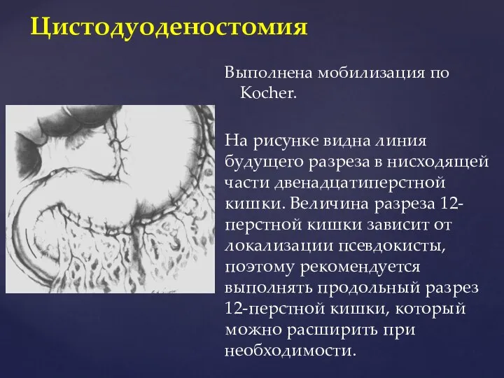 Цистодуоденостомия Выполнена мобилизация по Kocher. На рисунке видна линия будущего разреза в