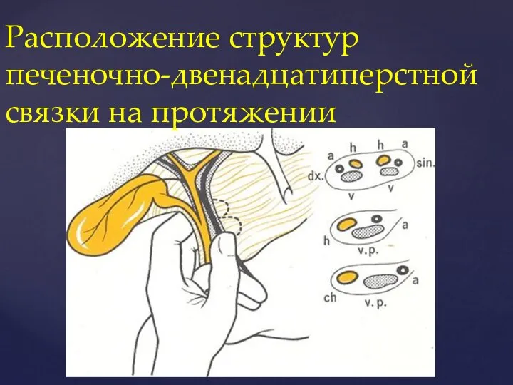 Расположение структур печеночно-двенадцатиперстной связки на протяжении