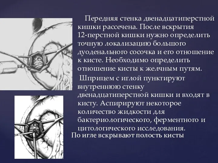 Передняя стенка двенадцатиперстной кишки рассечена. После вскрытия 12-перстной кишки нужно определить точную