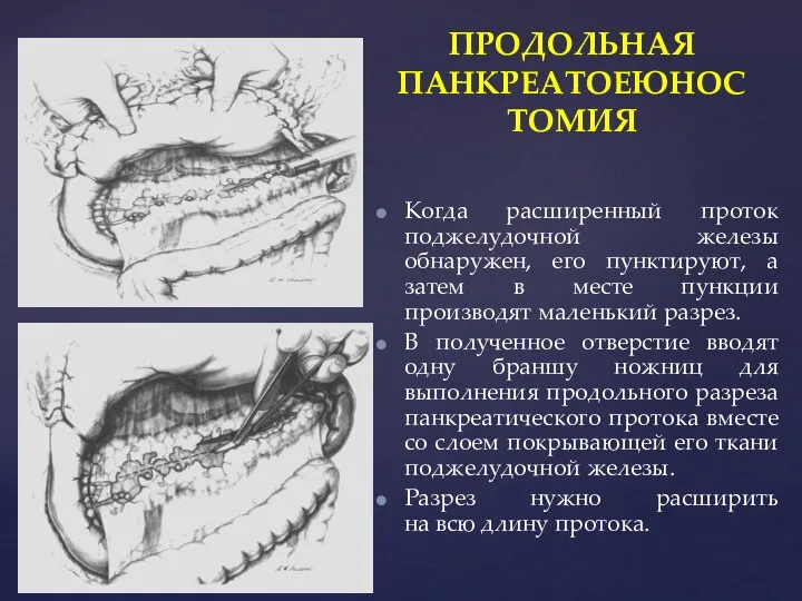 ПРОДОЛЬНАЯ ПАНКРЕАТОЕЮНОСТОМИЯ Когда расширенный проток поджелудочной железы обнаружен, его пунктируют, а затем