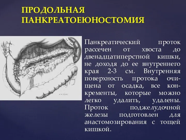 ПРОДОЛЬНАЯ ПАНКРЕАТОЕЮНОСТОМИЯ Панкреатический проток рассечен от хвоста до двенадцатиперстной кишки, не доходя