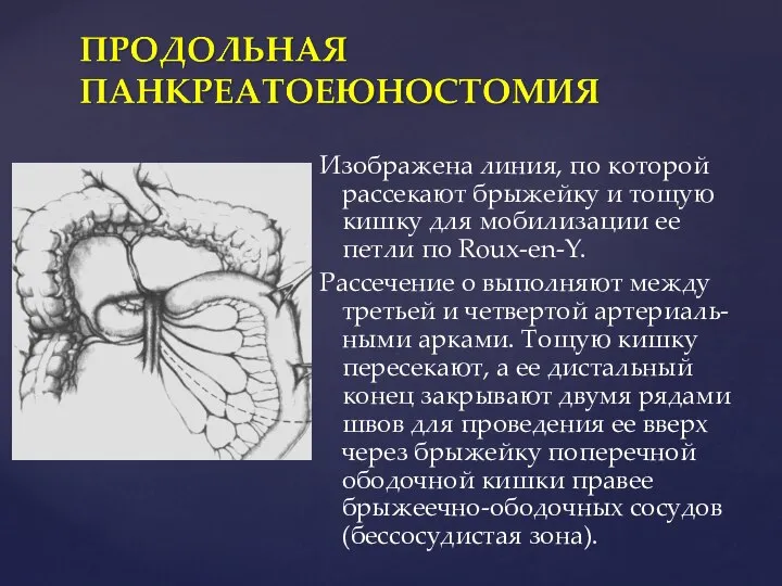 Изображена линия, по которой рассекают брыжейку и тощую кишку для мобилизации ее