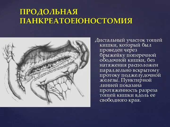 Дистальный участок тощей кишки, который был проведен через брыжейку поперечной ободочной кишки,