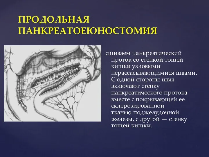 сшиваем панкреатический проток со стенкой тощей кишки узловыми нерассасывающимися швами. С одной