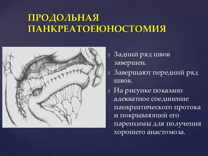 Задний ряд швов завершен. Завершают передний ряд швов. На рисунке показано адекватное