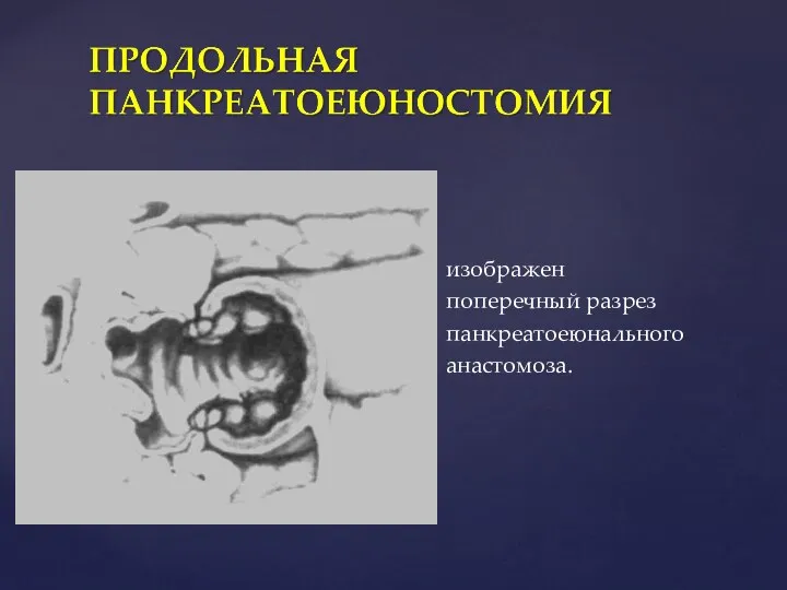 изображен поперечный разрез панкреатоеюнального анастомоза.