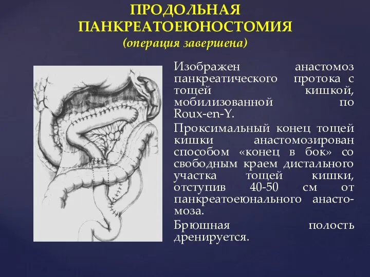 ПРОДОЛЬНАЯ ПАНКРЕАТОЕЮНОСТОМИЯ (операция завершена) Изображен анастомоз панкреатического протока с тощей кишкой, мобилизованной