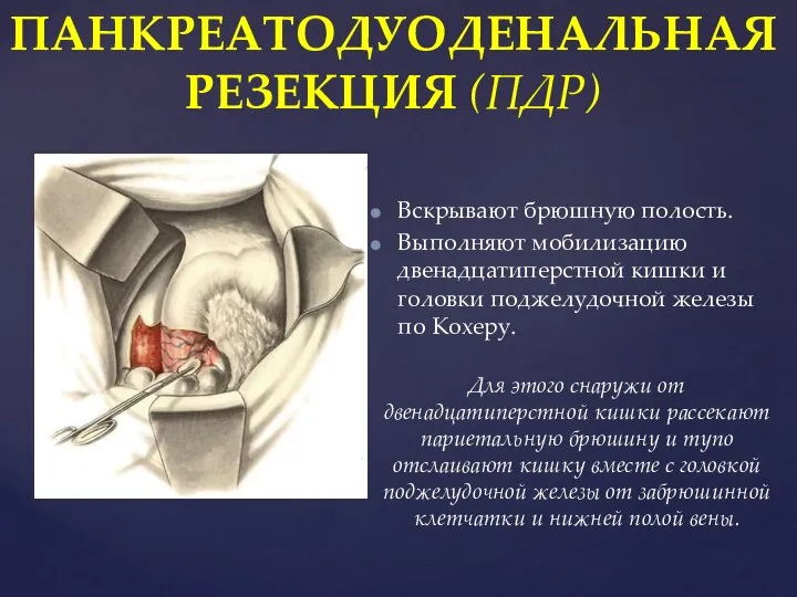 ПАНКРЕАТОДУОДЕНАЛЬНАЯ РЕЗЕКЦИЯ (ПДР) Вскрывают брюшную полость. Выполняют мобилизацию двенадцатиперстной кишки и головки