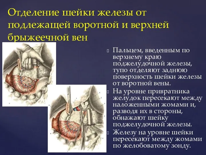 Отделение шейки железы от подлежащей воротной и верхней брыжеечной вен Пальцем, введенным