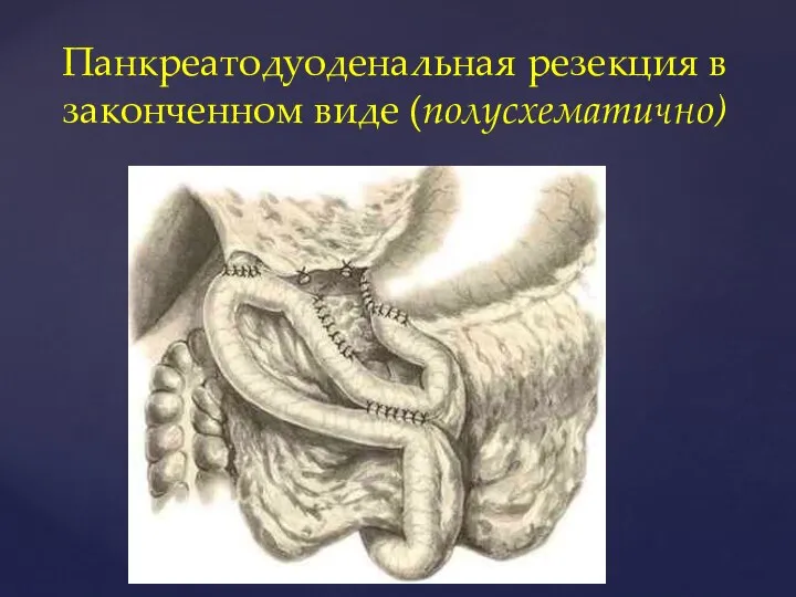 Панкреатодуоденальная резекция в законченном виде (полусхематично)