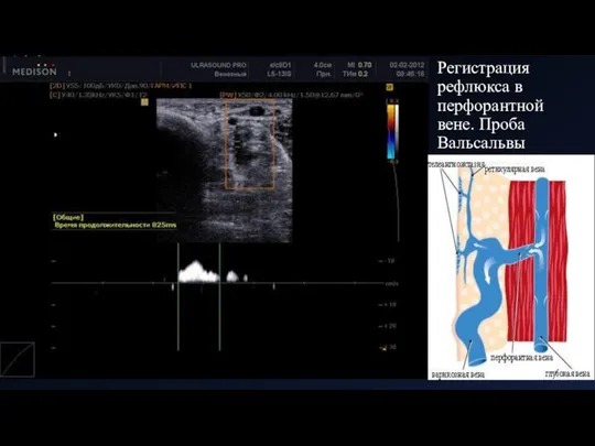 Регистрация рефлюкса в перфорантной вене. Проба Вальсальвы