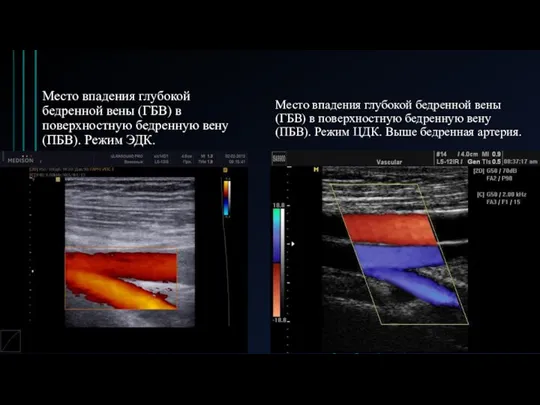 Место впадения глубокой бедренной вены (ГБВ) в поверхностную бедренную вену (ПБВ). Режим