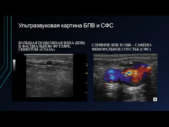 Ультразвуковая картина БПВ и СФС БОЛЬШАЯ ПОДКОЖНАЯ ВЕНА (БПВ) В ФАСЦИАЛЬНОМ ФУТЛЯРЕ.