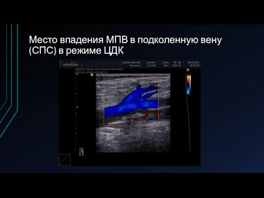 Место впадения МПВ в подколенную вену (СПС) в режиме ЦДК