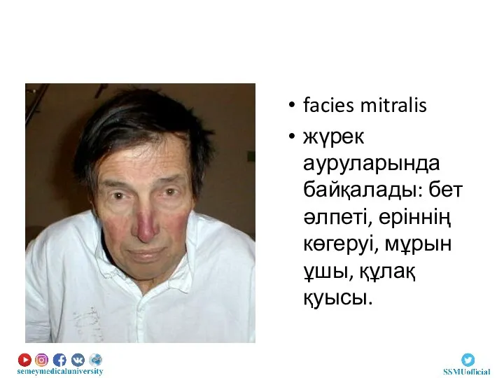 facies mitralis жүрек ауруларында байқалады: бет әлпеті, еріннің көгеруі, мұрын ұшы, құлақ қуысы.