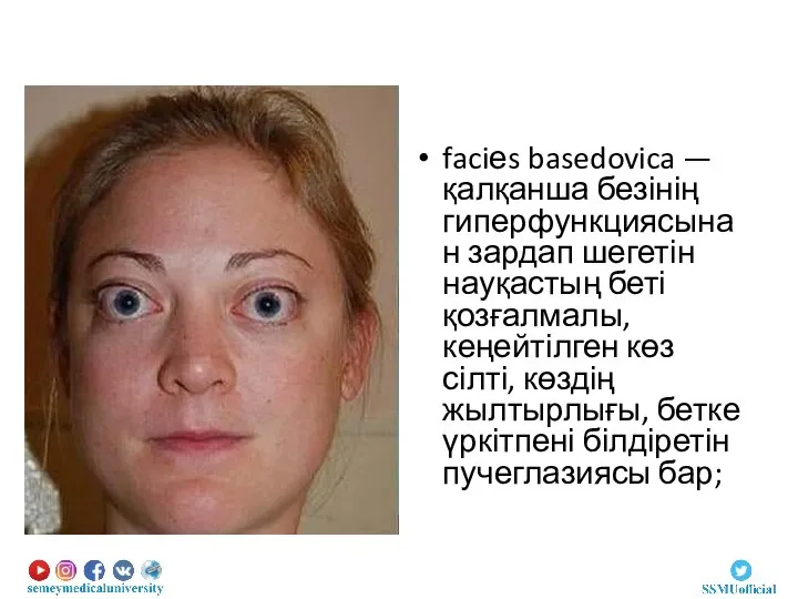 faciеs basedovica —қалқанша безінің гиперфункциясынан зардап шегетін науқастың беті қозғалмалы, кеңейтілген көз