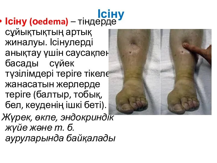 Ісіну Ісіну (оedema) – тіндерде сұйықтықтың артық жиналуы. Ісінулерді анықтау үшін саусақпен