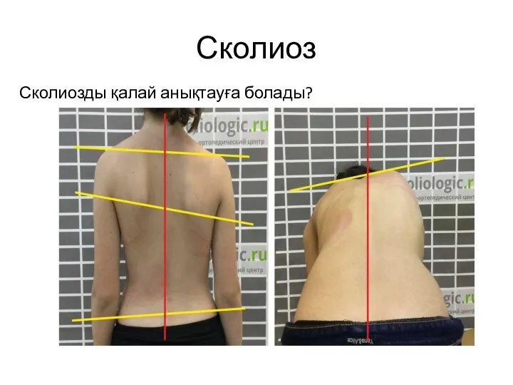 Сколиоз Сколиозды қалай анықтауға болады?