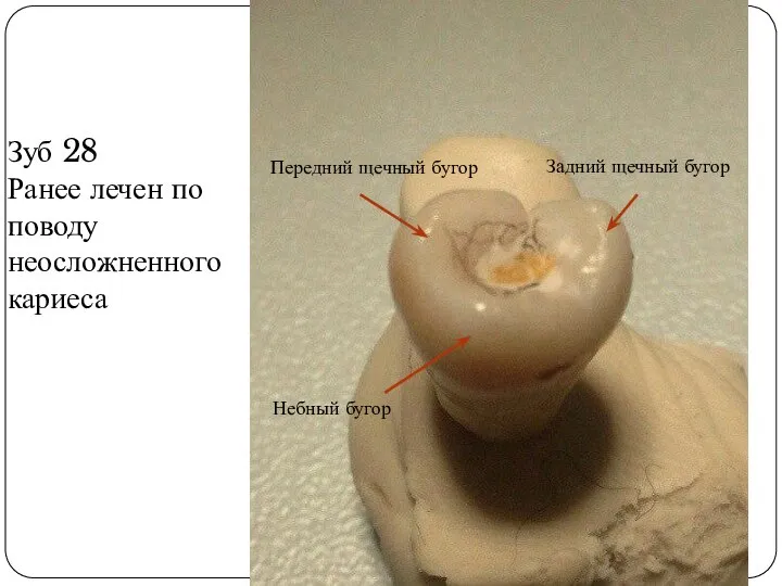 Зуб 28 Ранее лечен по поводу неосложненного кариеса Небный бугор Передний щечный бугор Задний щечный бугор