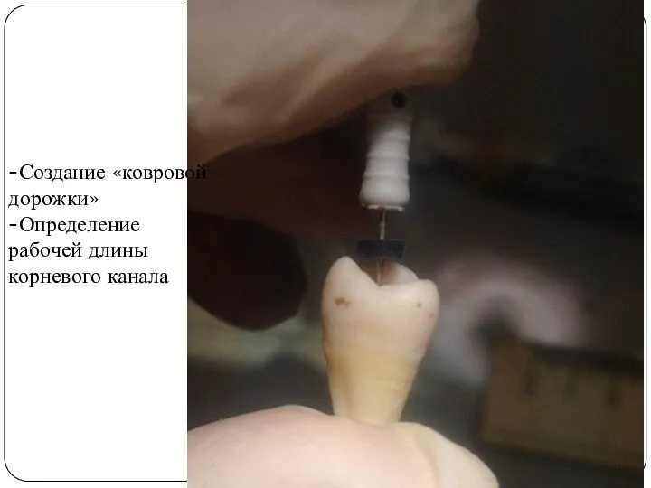 -Создание «ковровой дорожки» -Определение рабочей длины корневого канала