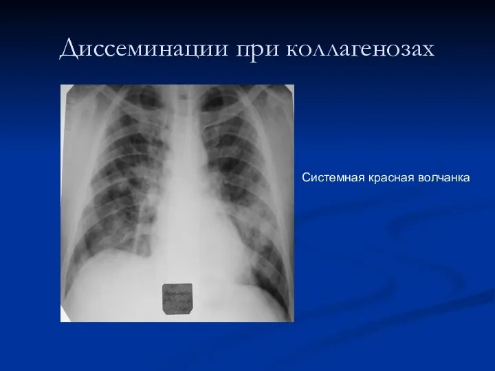 Диссеминации при коллагенозах Системная красная волчанка