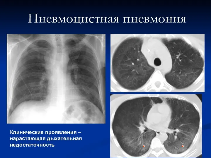 Пневмоцистная пневмония Клинические проявления – нарастающая дыхательная недостаточность