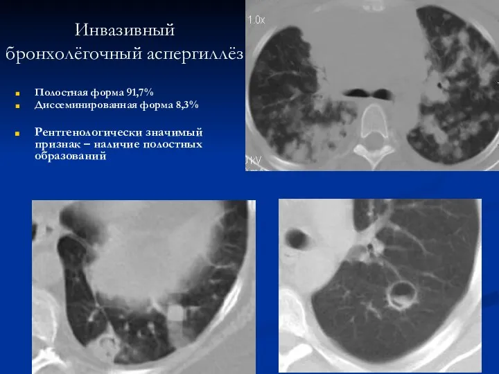 Инвазивный бронхолёгочный аспергиллёз Полостная форма 91,7% Диссеминированная форма 8,3% Рентгенологически значимый признак – наличие полостных образований