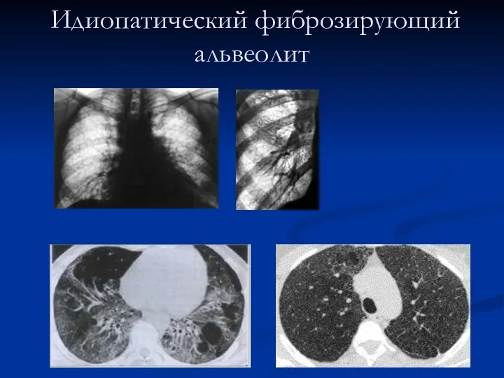 Идиопатический фиброзирующий альвеолит