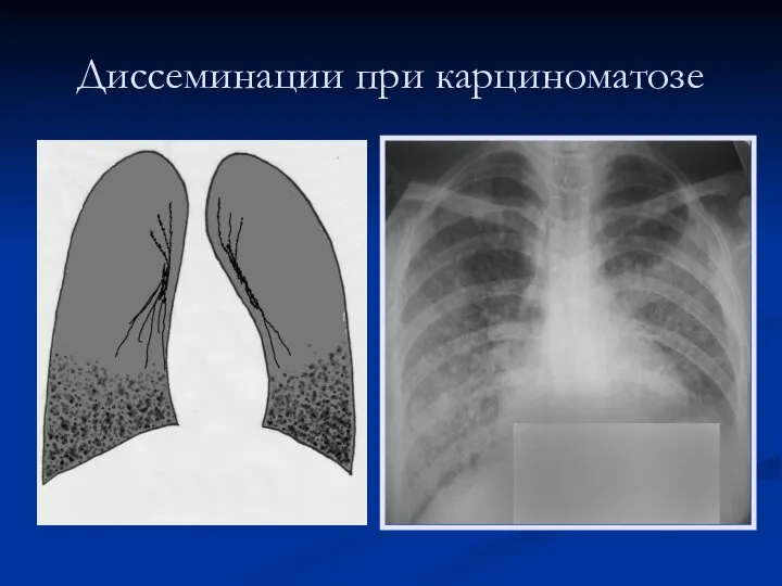 Диссеминации при карциноматозе