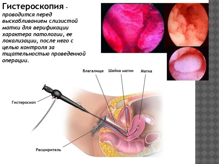 Гистероскопия - проводится перед выскабливанием слизистой матки для верификации характера патологии, ее