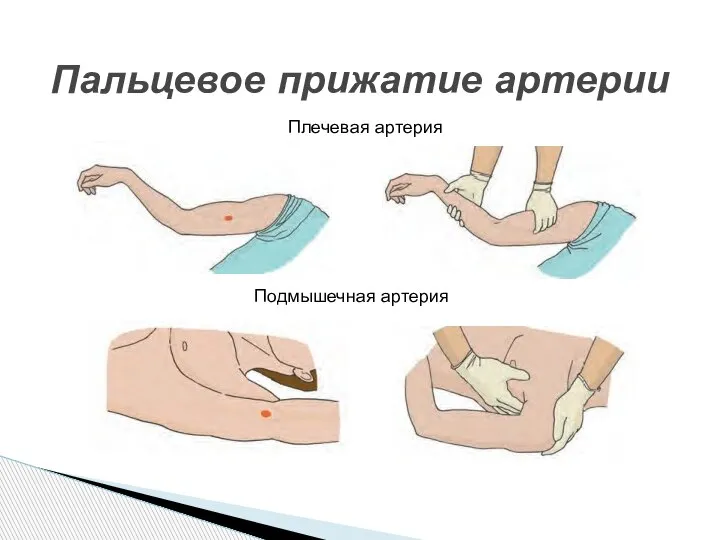 Пальцевое прижатие артерии Плечевая артерия Подмышечная артерия