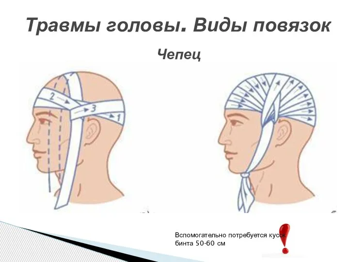 Травмы головы. Виды повязок Чепец Вспомогательно потребуется кусок бинта 50-60 см