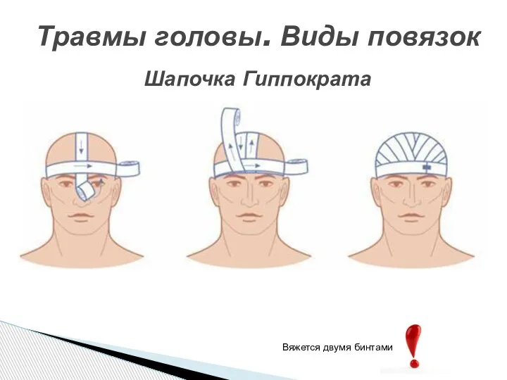 Травмы головы. Виды повязок Шапочка Гиппократа Вяжется двумя бинтами