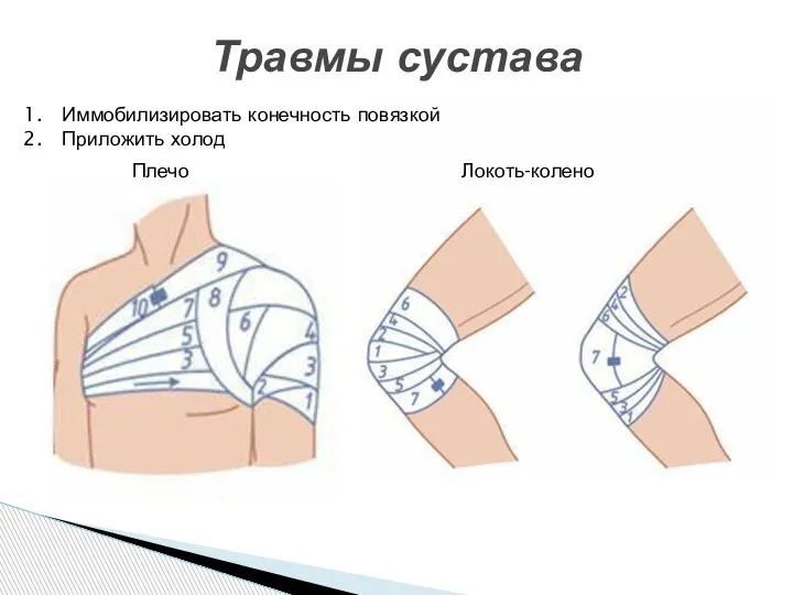 Травмы сустава Иммобилизировать конечность повязкой Приложить холод Плечо Локоть-колено