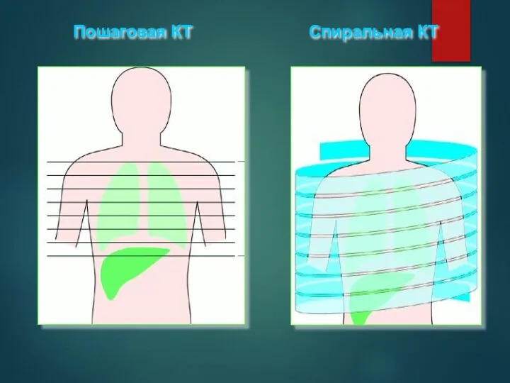 Пошаговая КТ Спиральная КТ