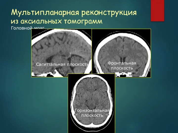 Мультипланарная реконструкция из аксиальных томограмм Головной мозг Сагиттальная плоскость Фронтальная плоскость Горизонтальная плоскость