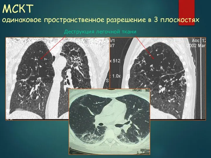 МСКТ одинаковое пространственное разрешение в 3 плоскостях Деструкция легочной ткани