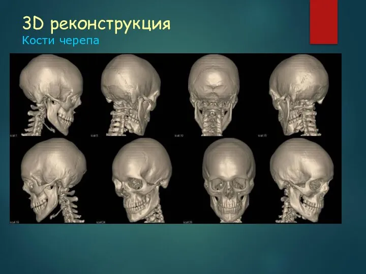 3D реконструкция Кости черепа