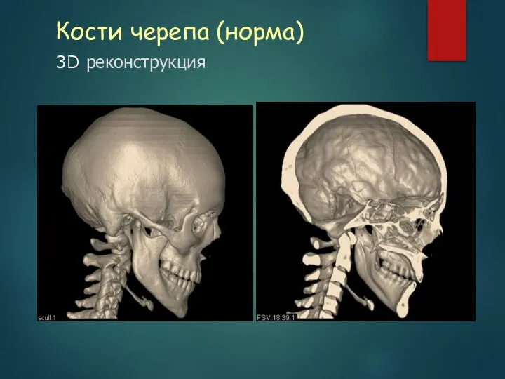 Кости черепа (норма) 3D реконструкция