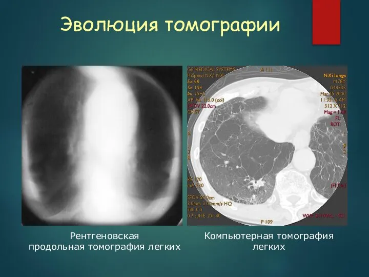 Эволюция томографии Рентгеновская продольная томография легких Компьютерная томография легких