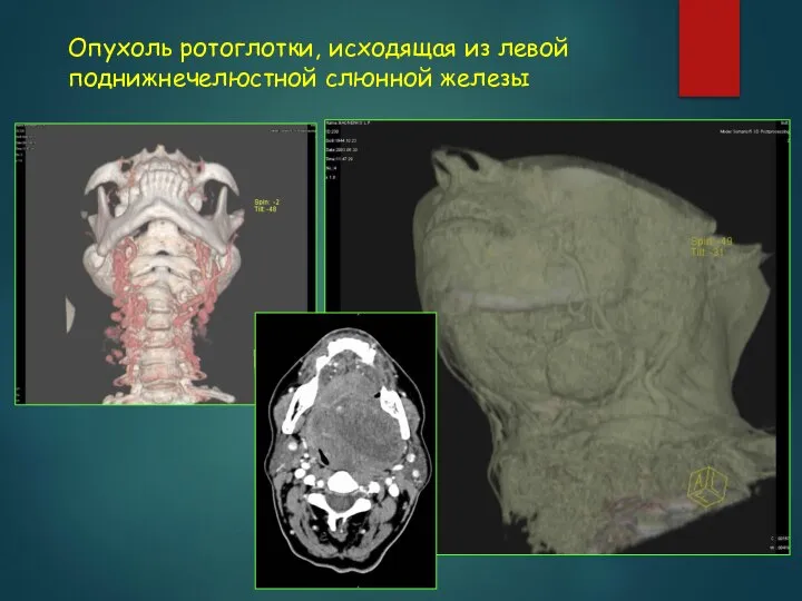 Опухоль ротоглотки, исходящая из левой поднижнечелюстной слюнной железы