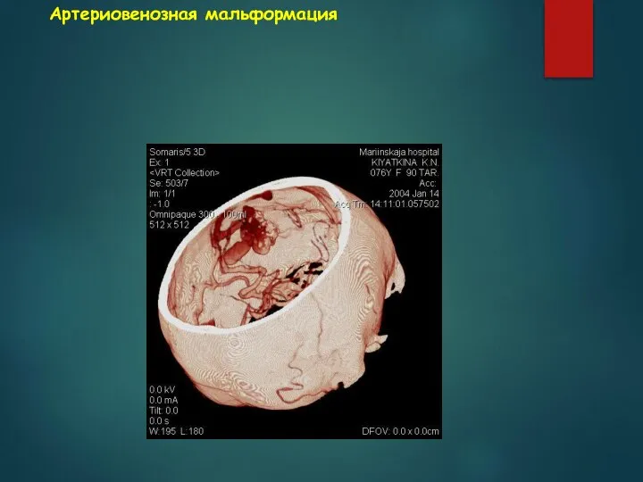 Артериовенозная мальформация