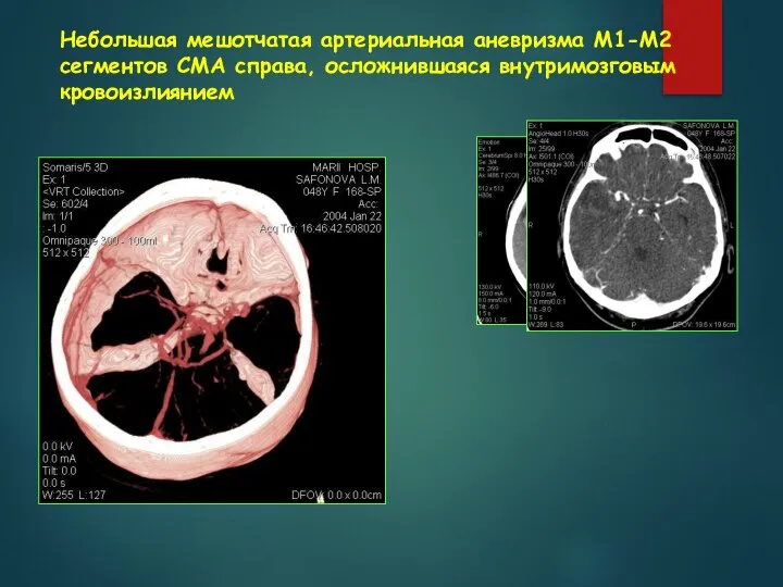 Небольшая мешотчатая артериальная аневризма М1-М2 сегментов СМА справа, осложнившаяся внутримозговым кровоизлиянием