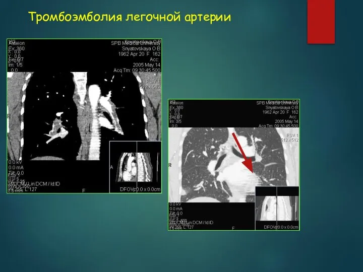 Тромбоэмболия легочной артерии