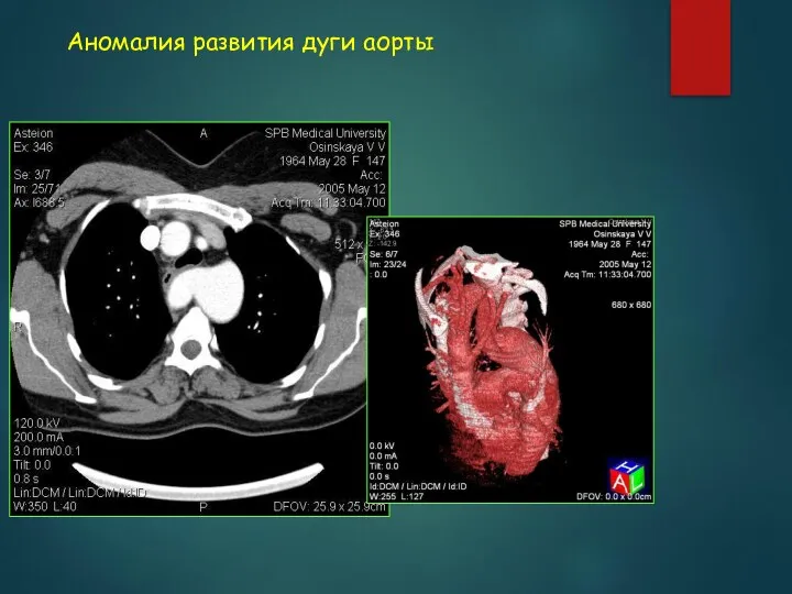 Аномалия развития дуги аорты