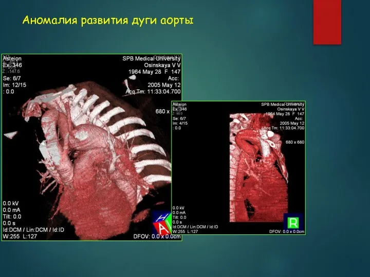 Аномалия развития дуги аорты