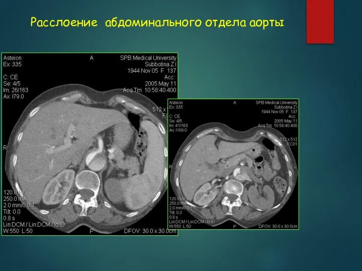 Расслоение абдоминального отдела аорты