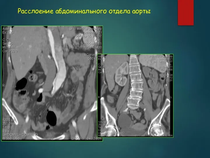 Расслоение абдоминального отдела аорты