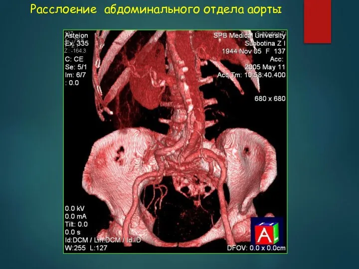 Расслоение абдоминального отдела аорты