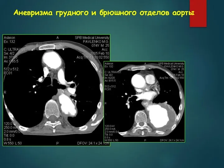 Аневризма грудного и брюшного отделов аорты